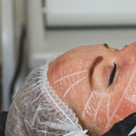 HIFU for Face Treatment