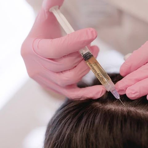 PRP for Hair Loss