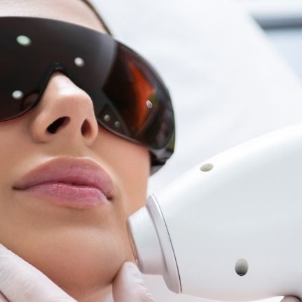 face hair laser